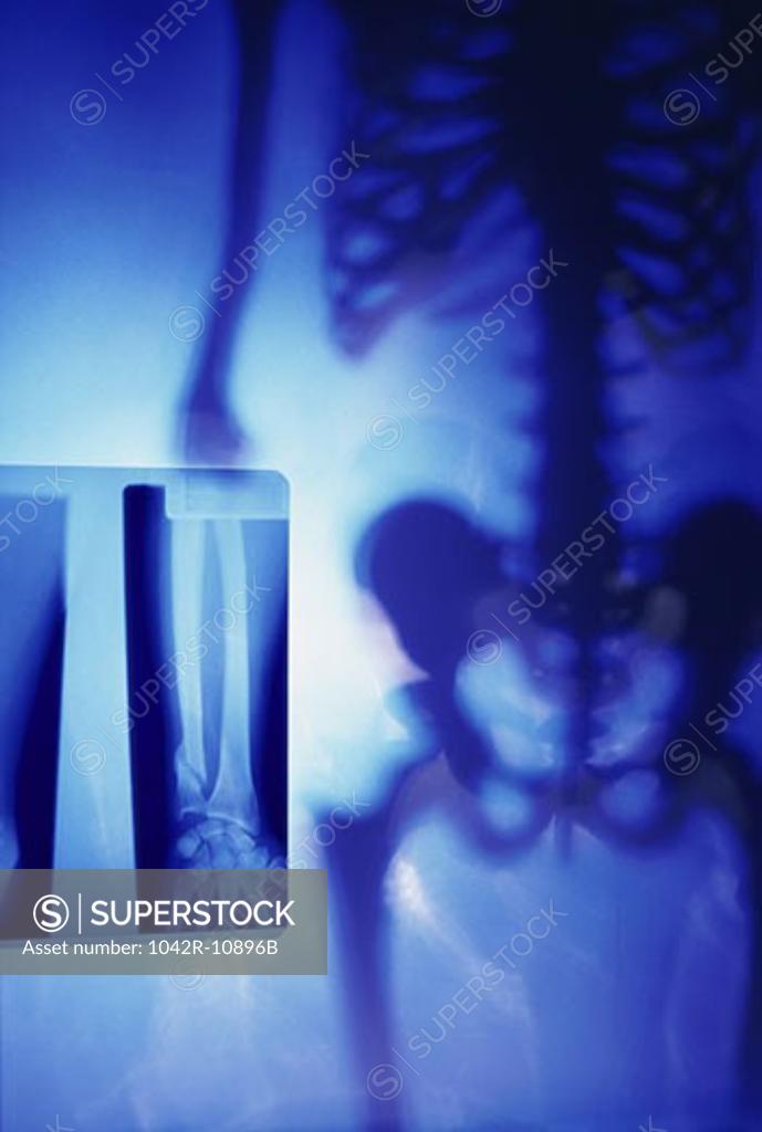 Stock Photo: 1042R-10896B X-ray of a human skeleton