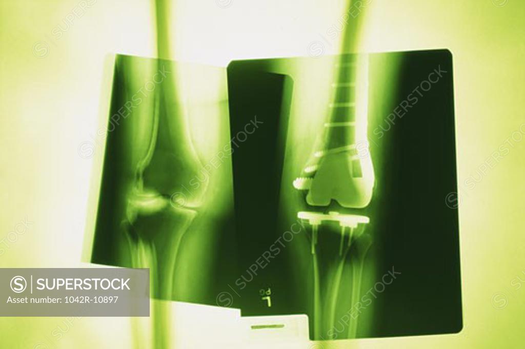 Stock Photo: 1042R-10897 X-ray of a human leg with metal screws and rods