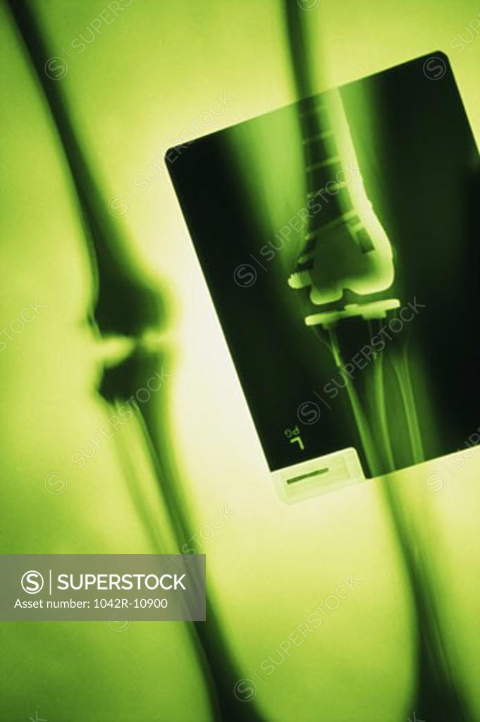 Stock Photo: 1042R-10900 X-ray of a human leg with metal screws and rods