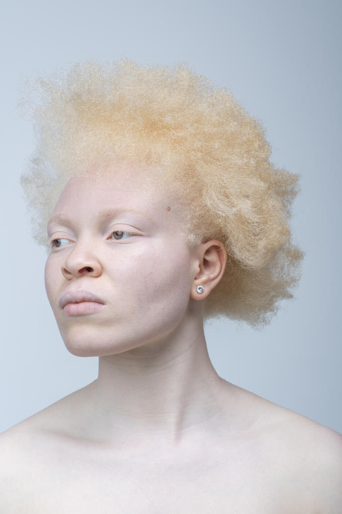Studio portrait of albino woman