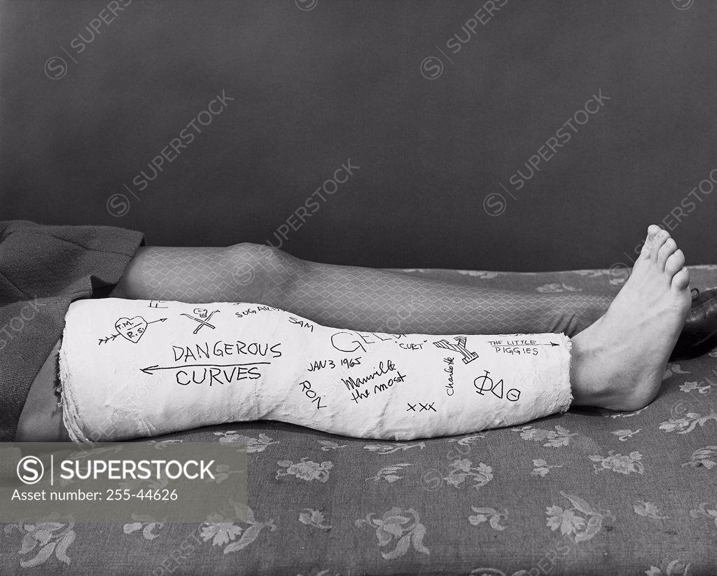 Stock Photo: 255-44626 Close-up of a woman's broken leg in a cast