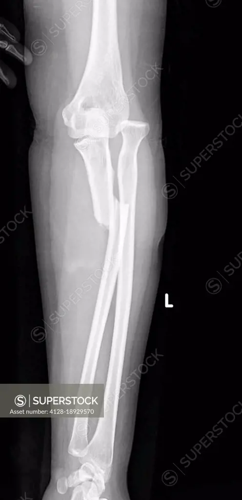 Monteggia fracture, X-ray