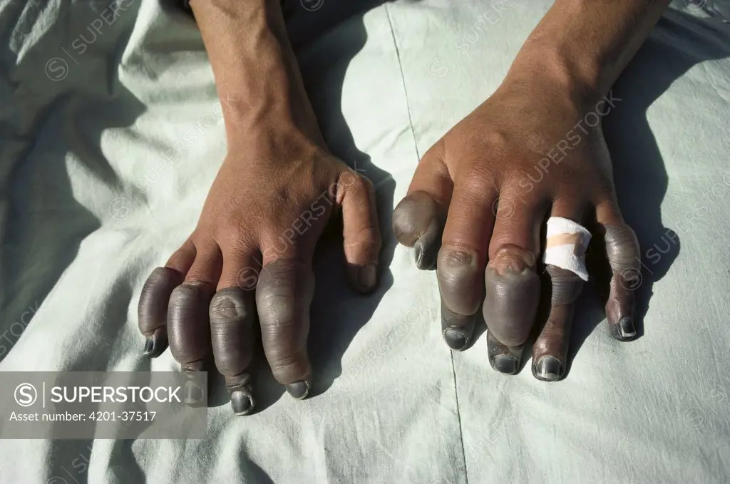 Andy Henderson's frostbitten fingers, photographed in Lhasa, one week after descending the North Face of Mt Everest, Tibet
