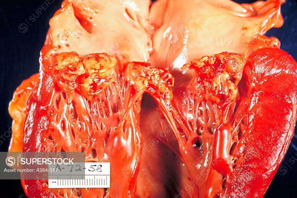Stock Photo: 4384-197 The left ventricle of heart has been opened to show mitral valve fibrin vegetations due to infection with Haemophilus parainfluenzae, which was caused by subacute bacterial endocarditis.