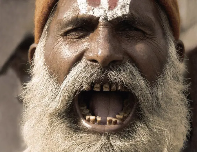 Man with beard opening mouth to show gapped and decaying teeth.