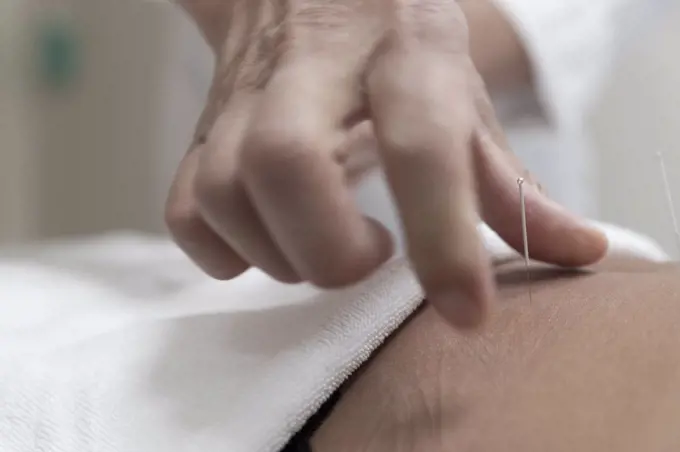 a doctor doing acupuncture puts a needle in a patient's stomach