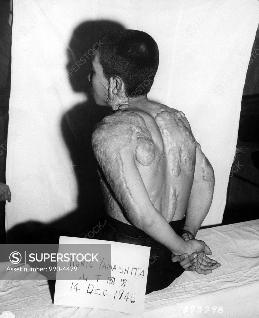 Stock Photo: 990-4479 Japan, Nagasaki, Nagasaki atomic bomb burn victim sitting on the bed, December 1946